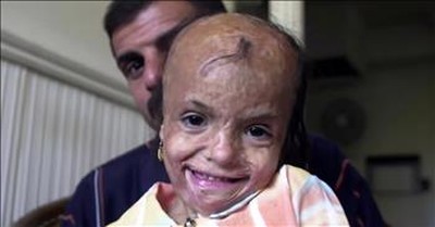 Badly Scarred Young Girl Receives Care After Mother's Selfless Sacrifice 