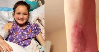 Mom Shares Terrifying Discovery That 'Pinch' on 9-Year-Old's Arm Was Brown Recluse Spider Bite