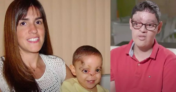 Doctors Thought He'd Never Survive, but Faithful Parents Refuse to Give Up on Baby with No Nose