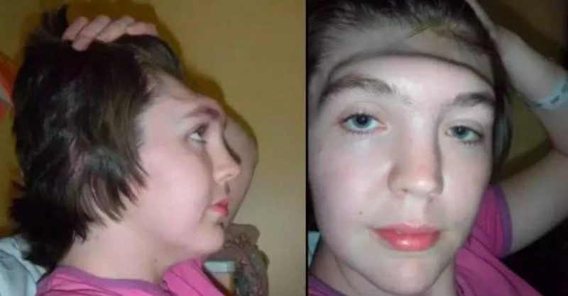 Woman Warns Others ‘Learn From My Mistake’ after She Lost Forehead from a Bad Habit