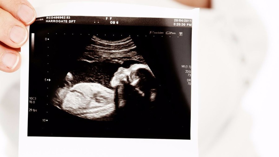 Missouri Senate Advances Bill Banning Abortion after 8 Weeks