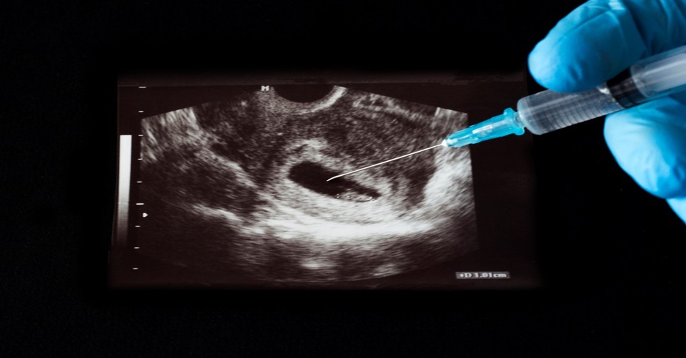 Does “Thou Shalt Not Kill” Apply to Abortion?
